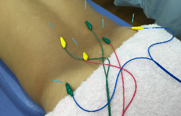 パルス(電気鍼)